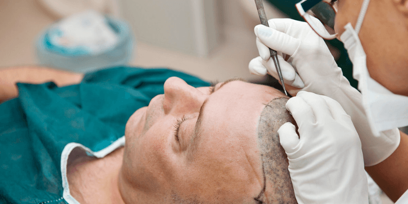 Haartransplantation istanbul für junge Erwachsene: Eine langfristige Investition